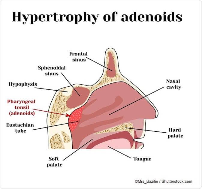 enlarged tonsils snoring adults